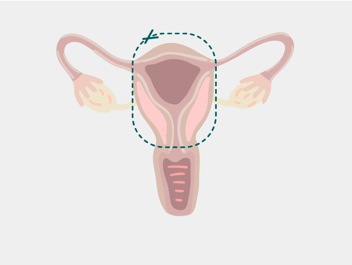 Hysterectomy