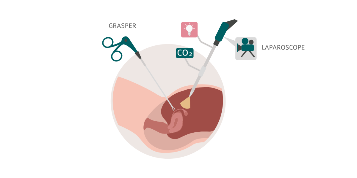 Laparoscopy diagram