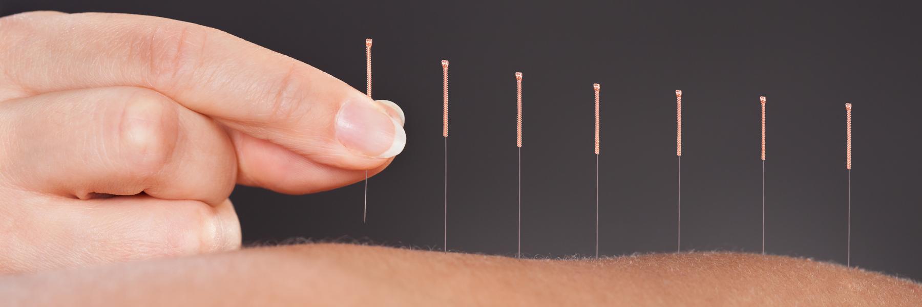 Acupuncture for endo pain relief