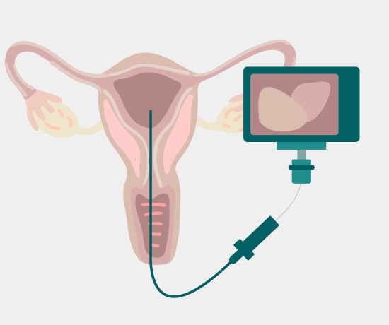 Hysteroscopy camera