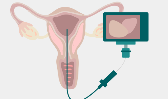 Hysteroscopy camera