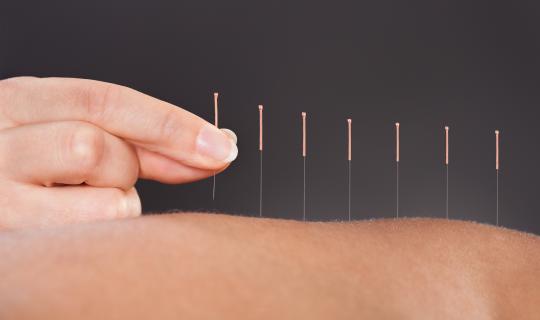 Acupuncture for endo pain relief